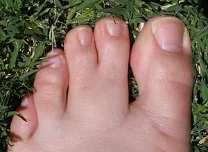 webbed-toes.jpg