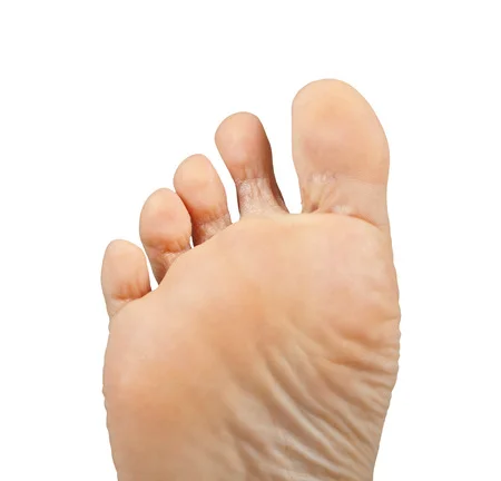 25659400_S_athletes_foot_fungus_toes.jpg