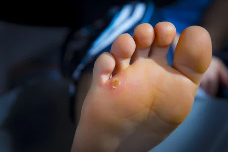 58286020_S_corn_callus_foot_bare_jeans_skin_toes.jpg
