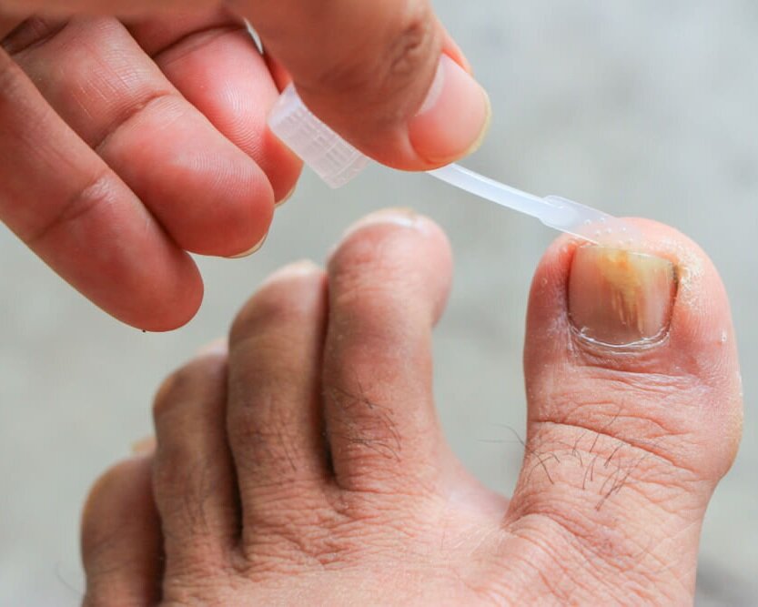 Brooklyn Podiatrist Discusses Melanoma And Other Skin/Nail Problems  Affecting The Feet — NYSPMA | New York State Podiatric Medical Association