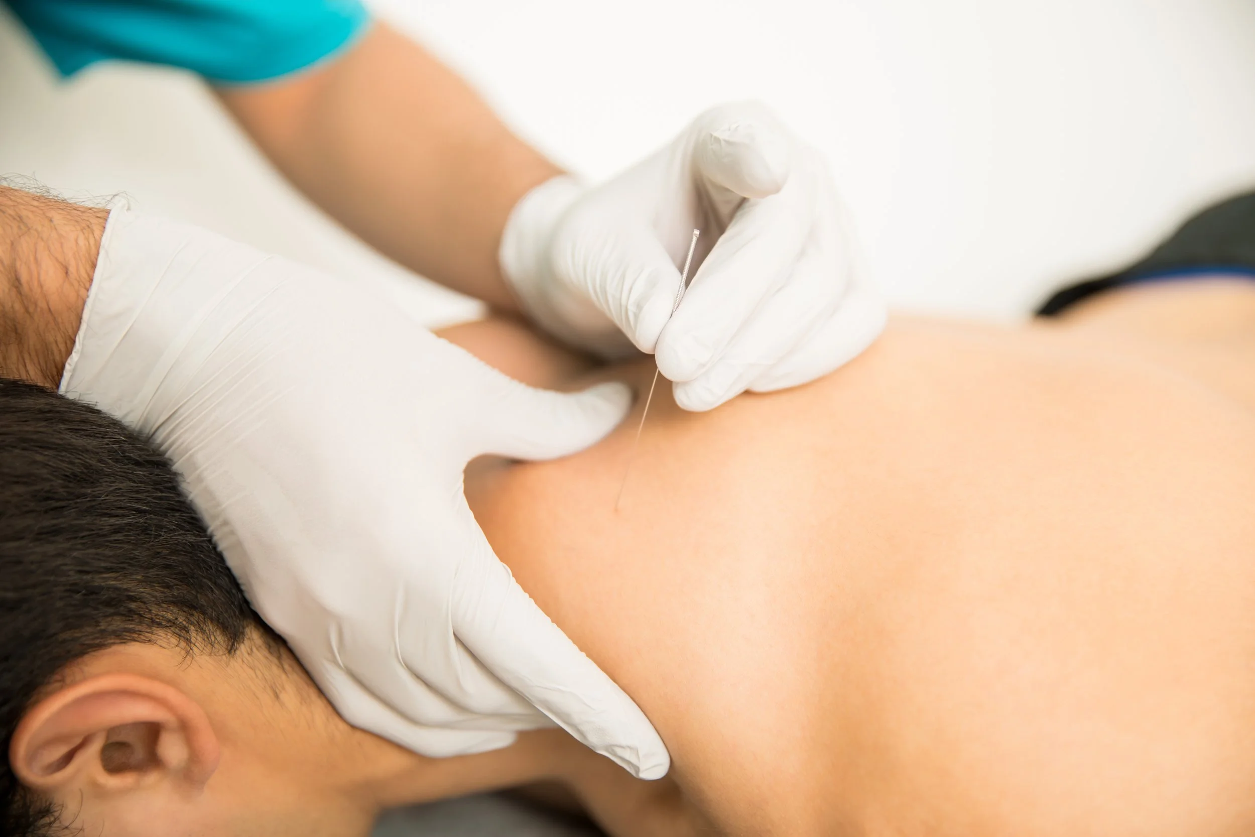 The Recovery Reset: How Dry Needling Therapy in Springwood Helps With Training Stiffness and Muscle Tension