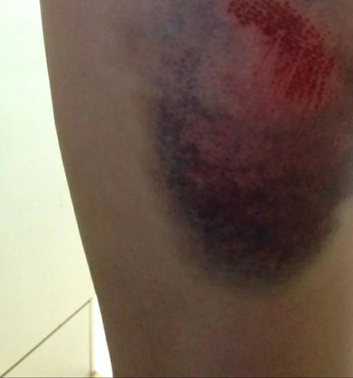 Ouch. Alice's bruise.