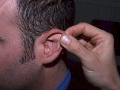  The ear canal tends to have a slight anterior bulge and it is usually easier to see the posterior part of the drum than the anterior part. The canal may be partly straightened by pulling the pinna backwards and upwards during examination. In infants