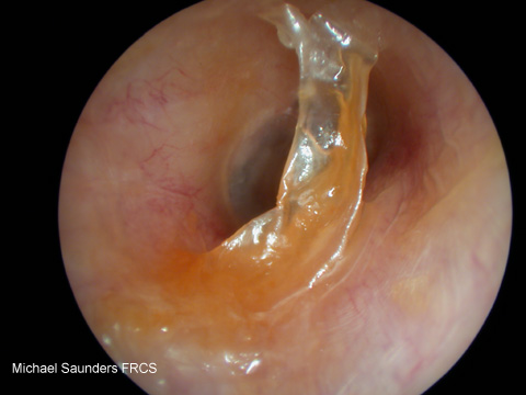  Note the appearance of the ear canal including it’s diameter and the presence of wax. It is usual to see some wax in almost every ear. 