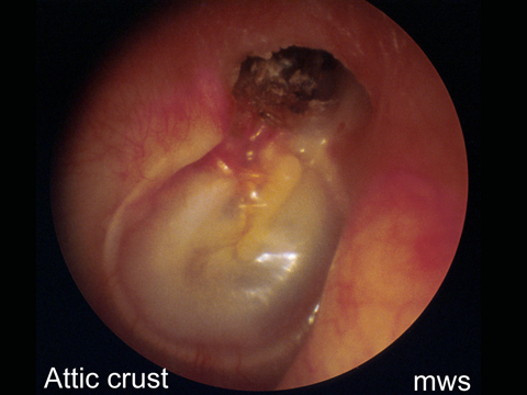  Wax is not normally present in the inner third of the ear canal. It’s presence there may indicate inappropriate use of cotton buds to clean the ears of it may be a dried up crust, overlying more significant pathology such as a perforation or cholest