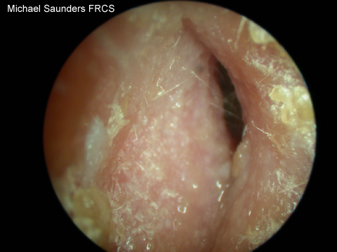  In otitis externa, an infective / inflammatory condition, the canal may be so swollen that a view into the ear is impossible. 