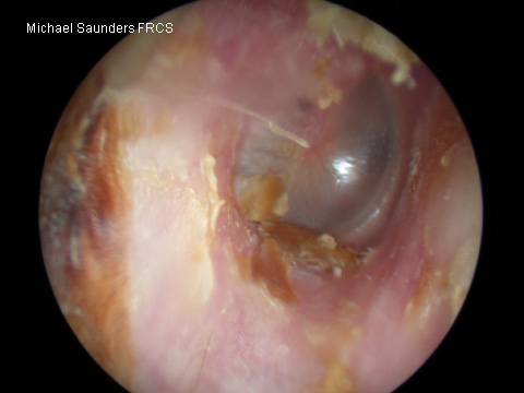  This is chronic otitis externa. Although the canal wall is not swollen, the skin is excoriated and red. The drum is essentially normal. 