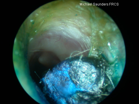  Foreign body in the canal of a child (wax crayon) note the drum visible distal to the foreign body. 