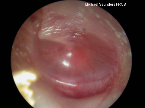  As the drum retracts so does the handle of the malleus and it may appear to be shortened on otoscopy. The lateral process will also become much more prominent than normal. 