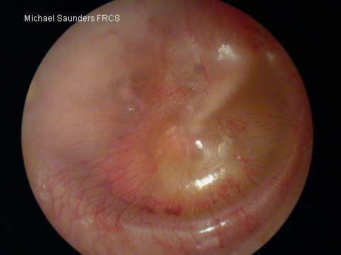  Mild retraction may be difficult to identify. The margin of the drum (annulus may become more pronounced as in this image. 