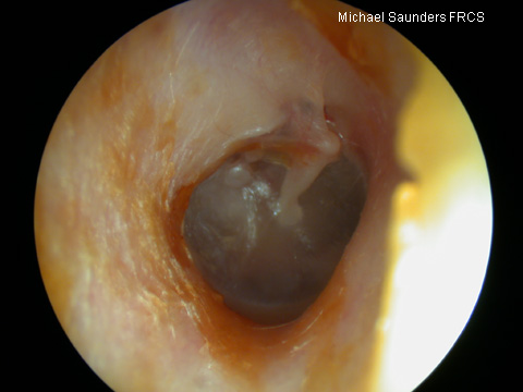  As the drum becomes increasingly retracted, it drapes over the ossicular chain, and the incus and stapes head may be outlined. 