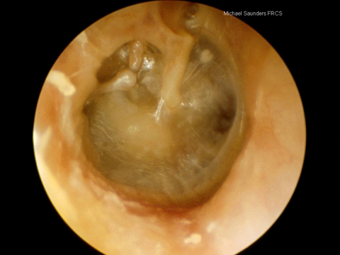  Eventually, nearly all the middle ear space may be lost and the drum comes into contact with the medial wall of the middle ear (this is known as atelectasis). 