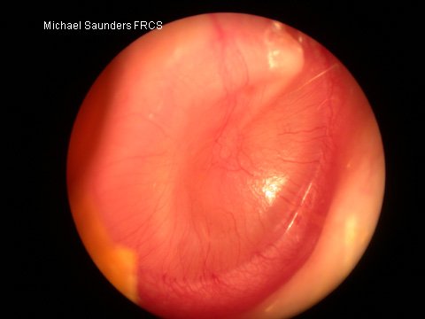  Compare this drum with the normal one. It is opaque and pale. There is slight injection of blood vessels. This is one appearance of glue ear. 