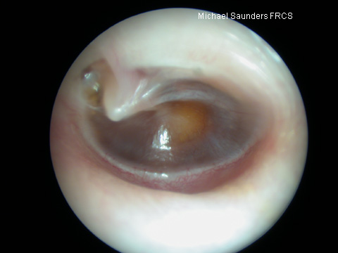  Glue ear may make the drum yellow or even darker than normal. Note also how retracted this drum is and how prominent the lateral process of the malleus appears. Blood in the middle ear will give the ear a blue or brown colour, this is called ahaemot