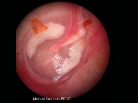   White Patches. &nbsp;White patches actually on the drum or within the drum itself are usually tympanosclerosis, which is deposition of calcium into the drum itself in response to trauma or infection. This is not normally of any consequence unless i