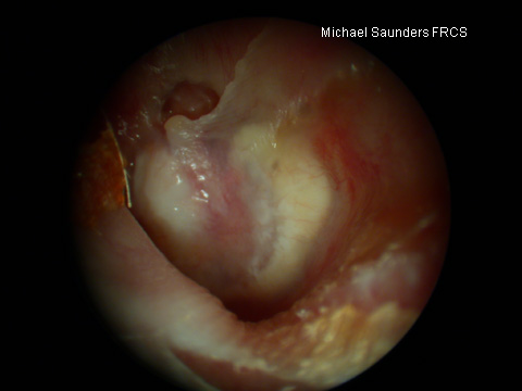  If the white patch is behind the drum, this may represent cholesteatoma (keratin in the middle ear). This normally needs to be treated surgically. 