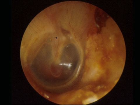   Red/Blue Lesions on the Drum. &nbsp;A diffusely red drum usually represents otitis media. More localised areas of discoloration can represent infection or vascular abnormalities behind the drum.This small red lesion at the tip of the malleus handle