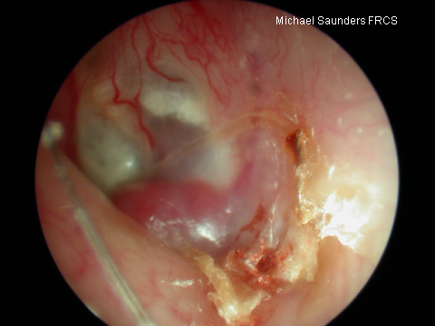  This red bulge in the canal is another glomus tumour (glomus jugulare). this is the tip of a much larger lesion involving the temporal bone. 