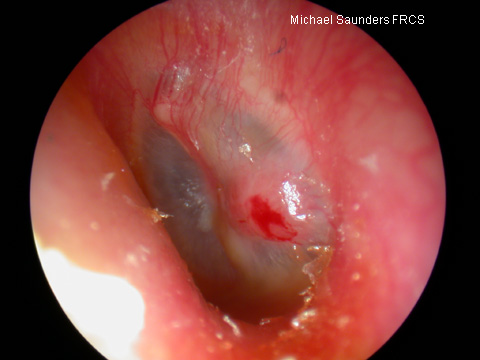  This red raised lesion on the posterior aspect of the drum is likely to be a granulation. Granulations are a localised infective process and may be a sign of more serious underlying disease such as cholesteatoma. 