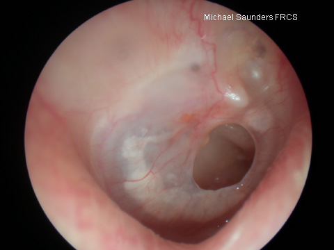  Safe perforation of the anterior part of the drum. A common cause of perforations in this position is a persistent defect after the extrusion of a grommet. 