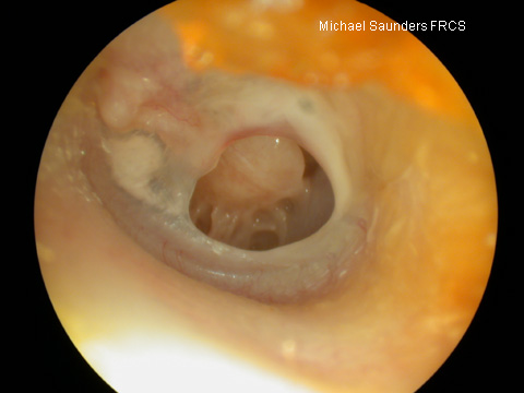  Inferior perforation. This is more likely to be as a result of chronic middle ear infection. 