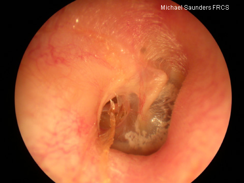  Posterior perforation. Although posterior perforations may represent more serious disease such as cholesteatoma, this is well described and dry. It is possible to make out the posterior margin of this defect. Traumatic perforations (eg barotrauma) a