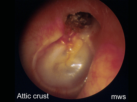   Unsafe &nbsp;perforations are not in fact holes in the drum, they represent a retraction of the tympanic membrane. Essentially a part of the drum becomes sucked inwards and may gradually enlarge. When the retraction becomes extensive, keratinous de