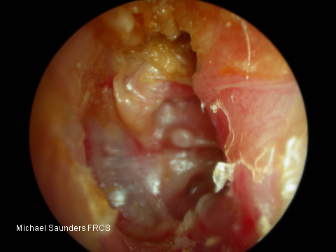  A posterior perforation where the posterior margin of the drum is also potentially unsafe. In this image, not only is the posterior margin of the drum not visible (you can imagine a retraction disappearing behind the posterior margin to the right of