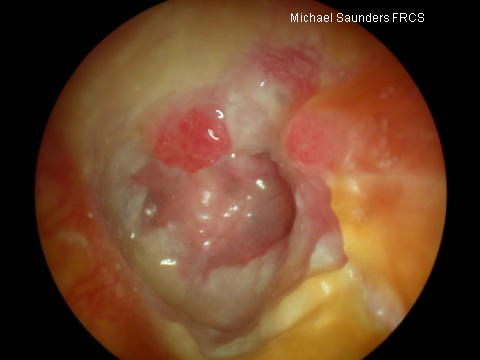  Granulations like this are often associated with underlying disease, particularly if they arise in the attic. 