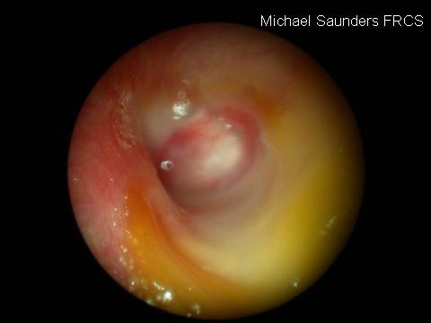  Realistically speaking, in primary care consultation it may not be possible to make out much of the anatomy of the drum in cholesteatoma as the ear is filled with infected discharge. An ear looking like this will need to be referred for ENT clinic a
