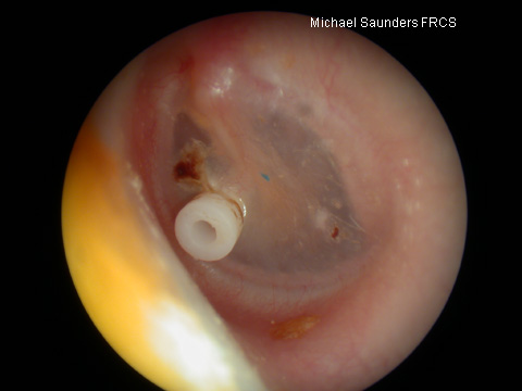  This is a grommet (ventilating tube) in the correct position in the drum. The hole in the middle should be clear of debris. Note a small dried crust above the grommet which is unimportant and may be a small clot remaining from surgery. 