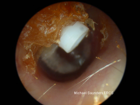  Just because you can see a grommet in the ear does not mean it is working. This one is clearly extruding and on it’s way out up the canal. Note the drum visible in the distance. 