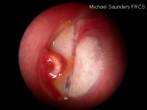  This grommet is in the correct position but is covered in infective granulation and blocked up. This will not be doing any good and may be responsible for a chronic discharge. Note also the extensive tympanosclerosis on the drum. 