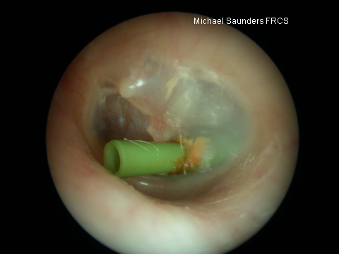  This is a  T-tube &nbsp;which is a permanent sort of grommet designed not to extrude on it’s own. These are not commonly used as they lead to a greater risk of perforation after removal, but in selected cases are preferable to repeated insertions of