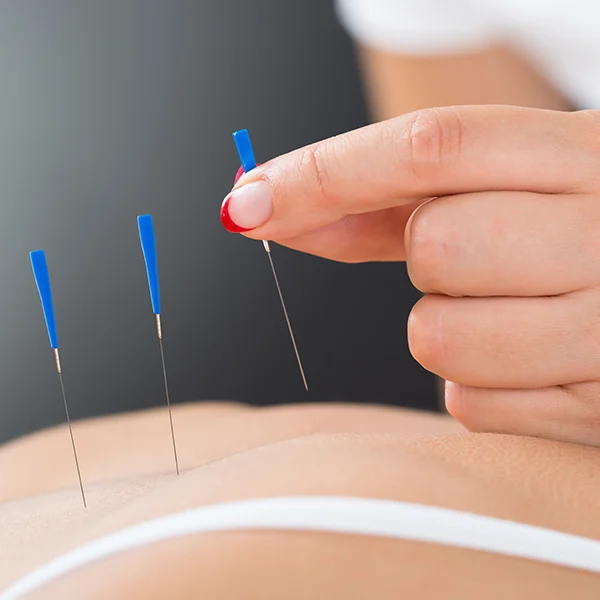 dry-needling.jpg
