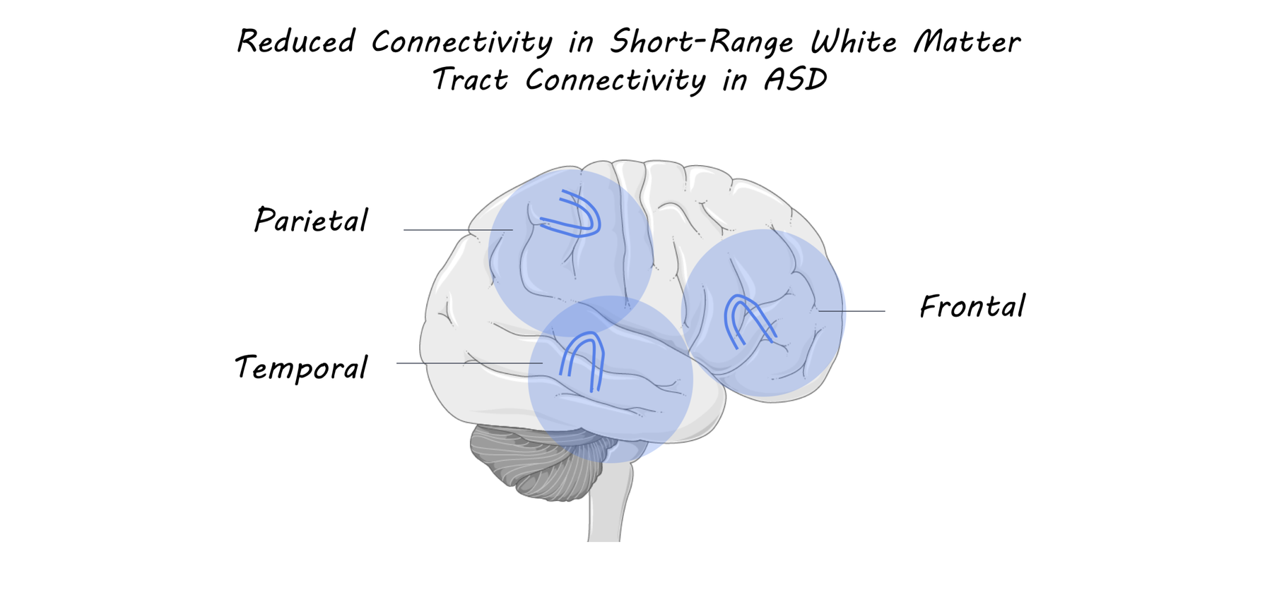 Decreased Short Range Brain Connections Linked To Social Symptoms Of Decreased Short Range Brain Connections Linked To Social Symptoms Of