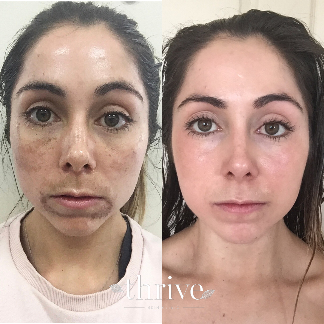 dermamelan peel near me