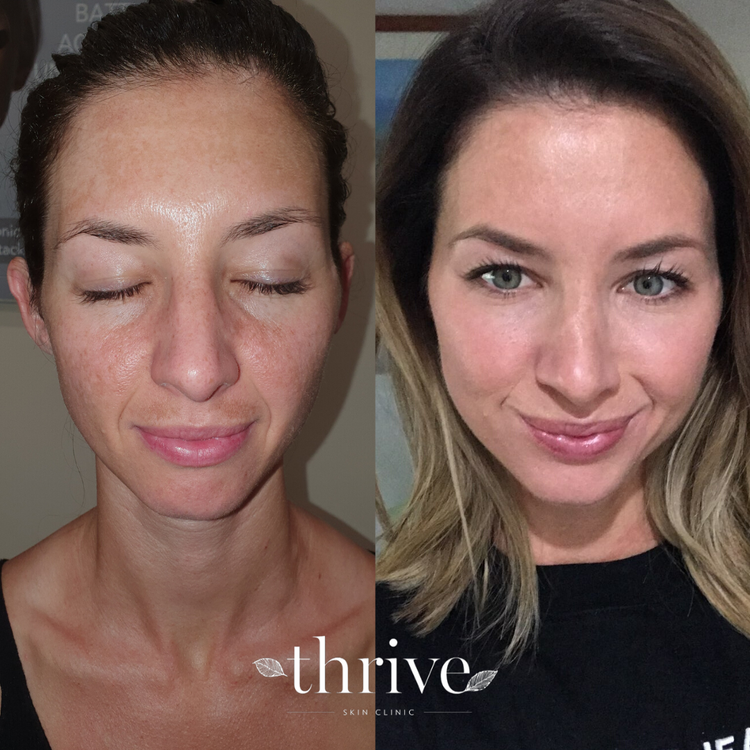 pre cosmelan &amp; 2 weeks post initial treatment