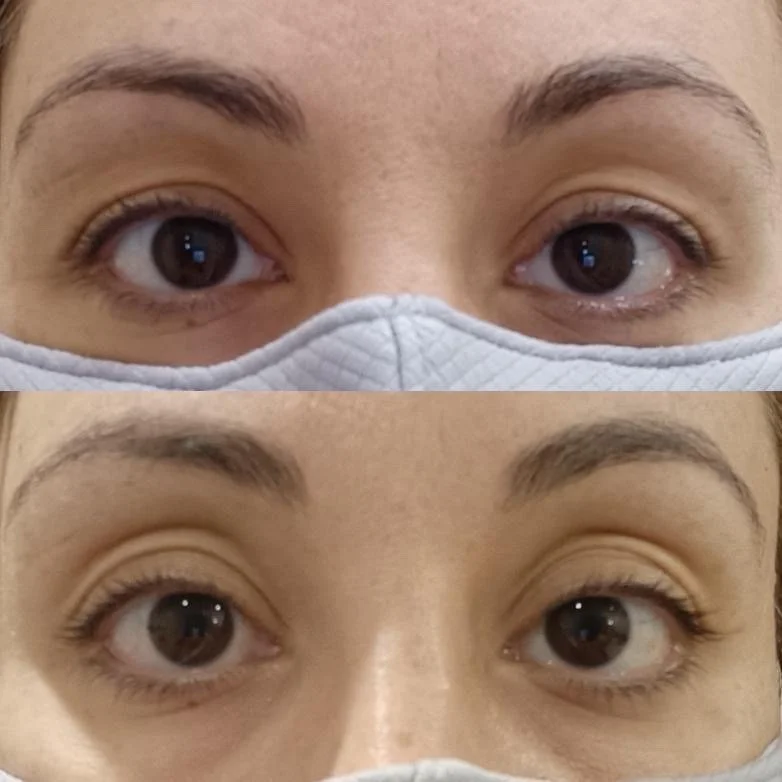 Tixel For Skin Rejuvenation Thrive Skin Clinic Wollongong