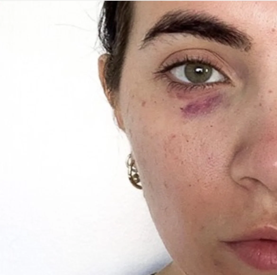 BruiseControl: Advice &amp;  Evidence from @drjemimagrant