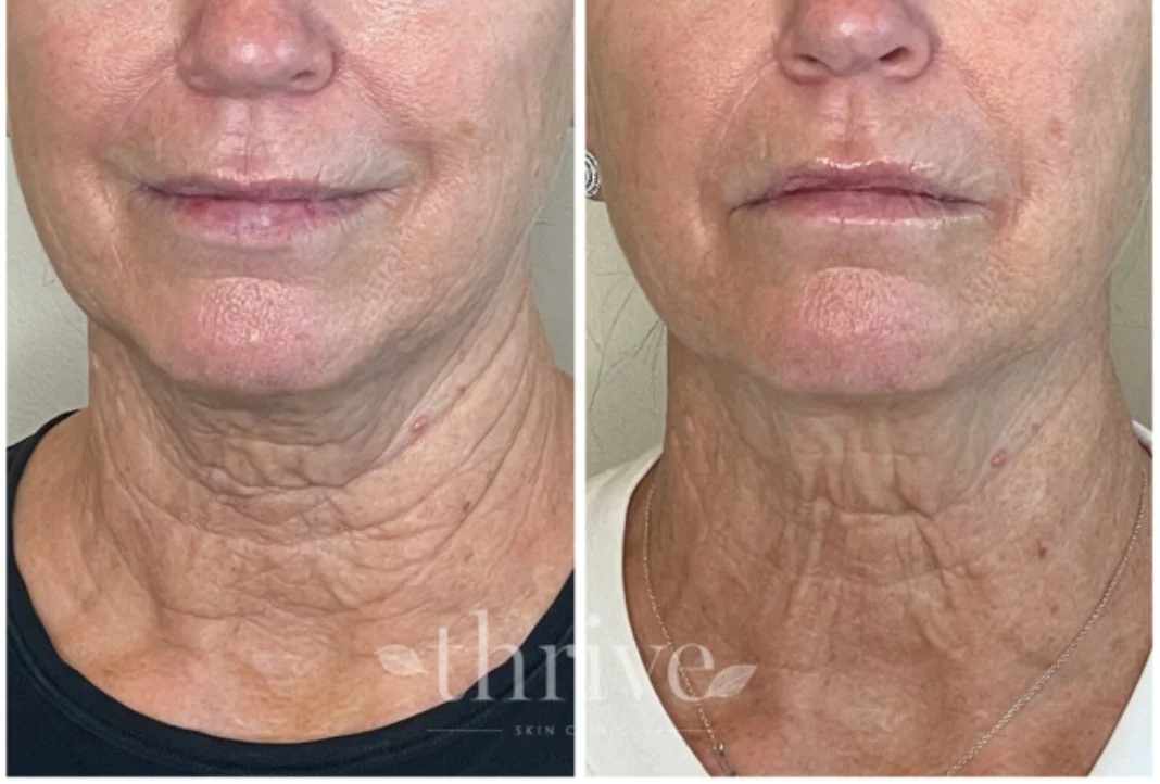 HIFU Neck  B and A .jpg