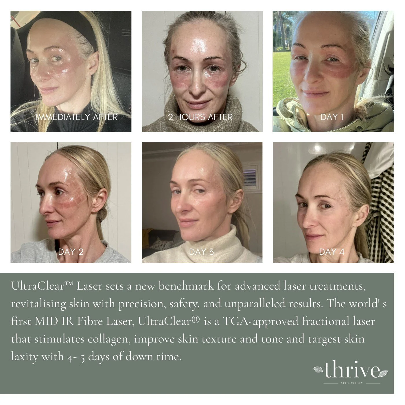 👁️ Lasers improve skin quality, which is the root cause of most under eye concerns. Different lasers can also address pigmentation or vascular structure. I prefer to use lasers first to improve undereye concerns, and will consider other options to t