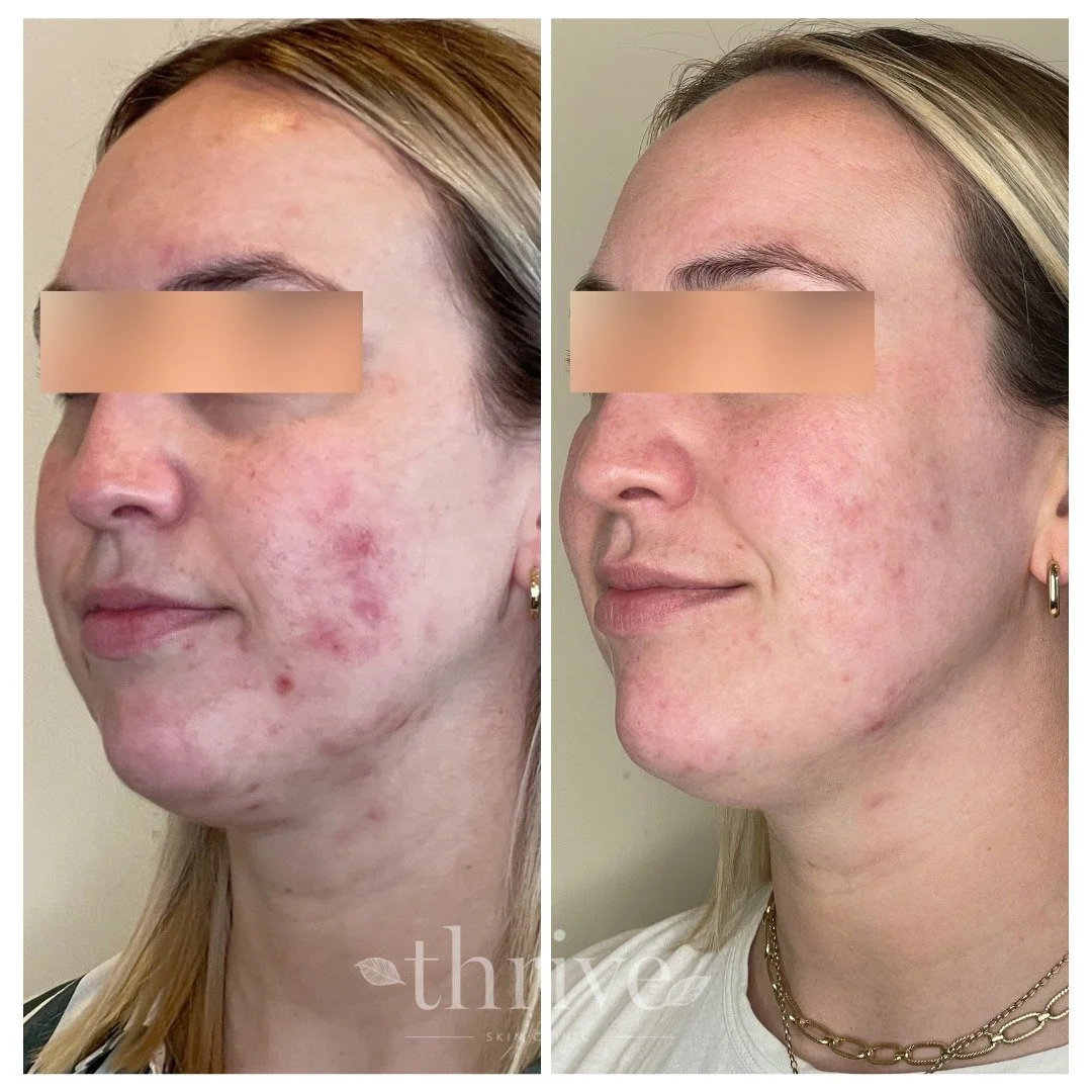 Before and after multimodal acne treatment at Thrive Clinic Wollongong