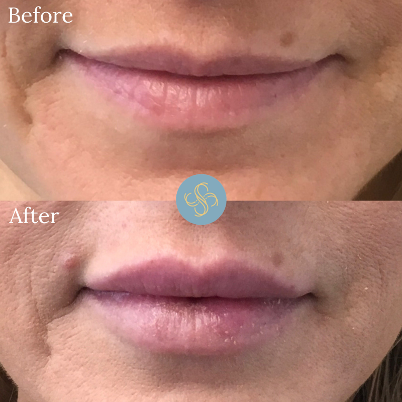 Before & After - Lips — Skintight Aesthetics