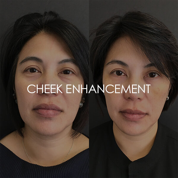 Cheek enhancement with dermal filler