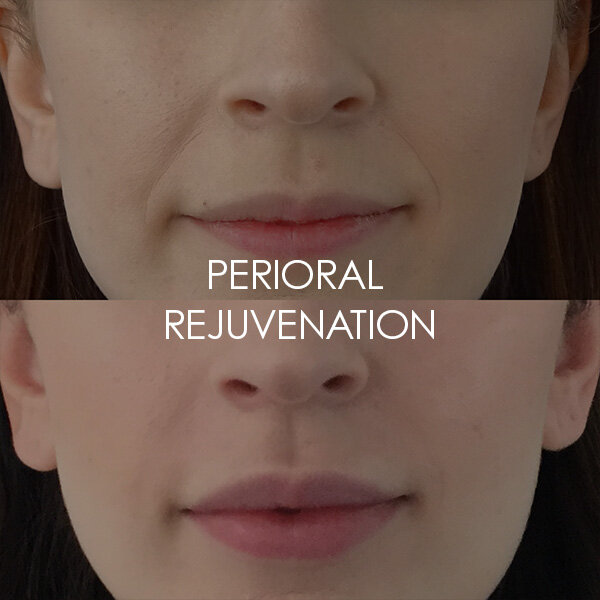 Smoothing of nasolabial folds &amp; Perioral lines 