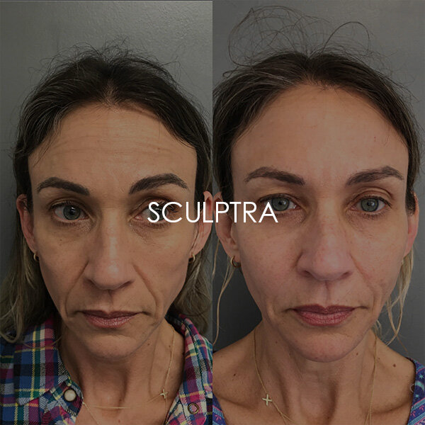 Sculptra Rejuvenation 