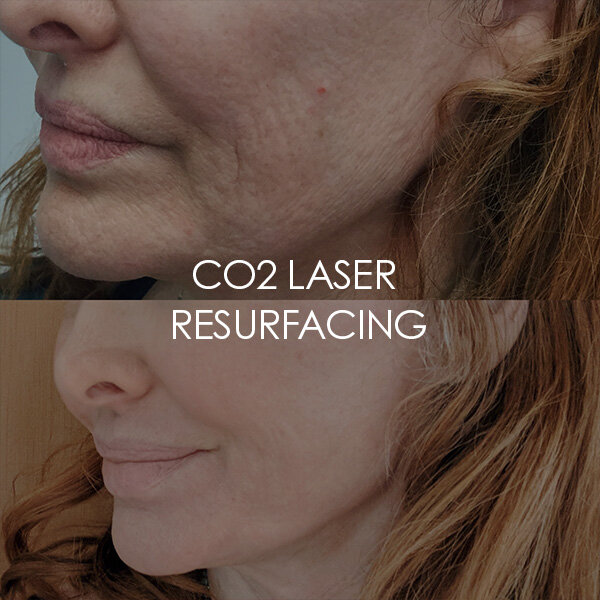 CO2 Laser resurfacing gallery