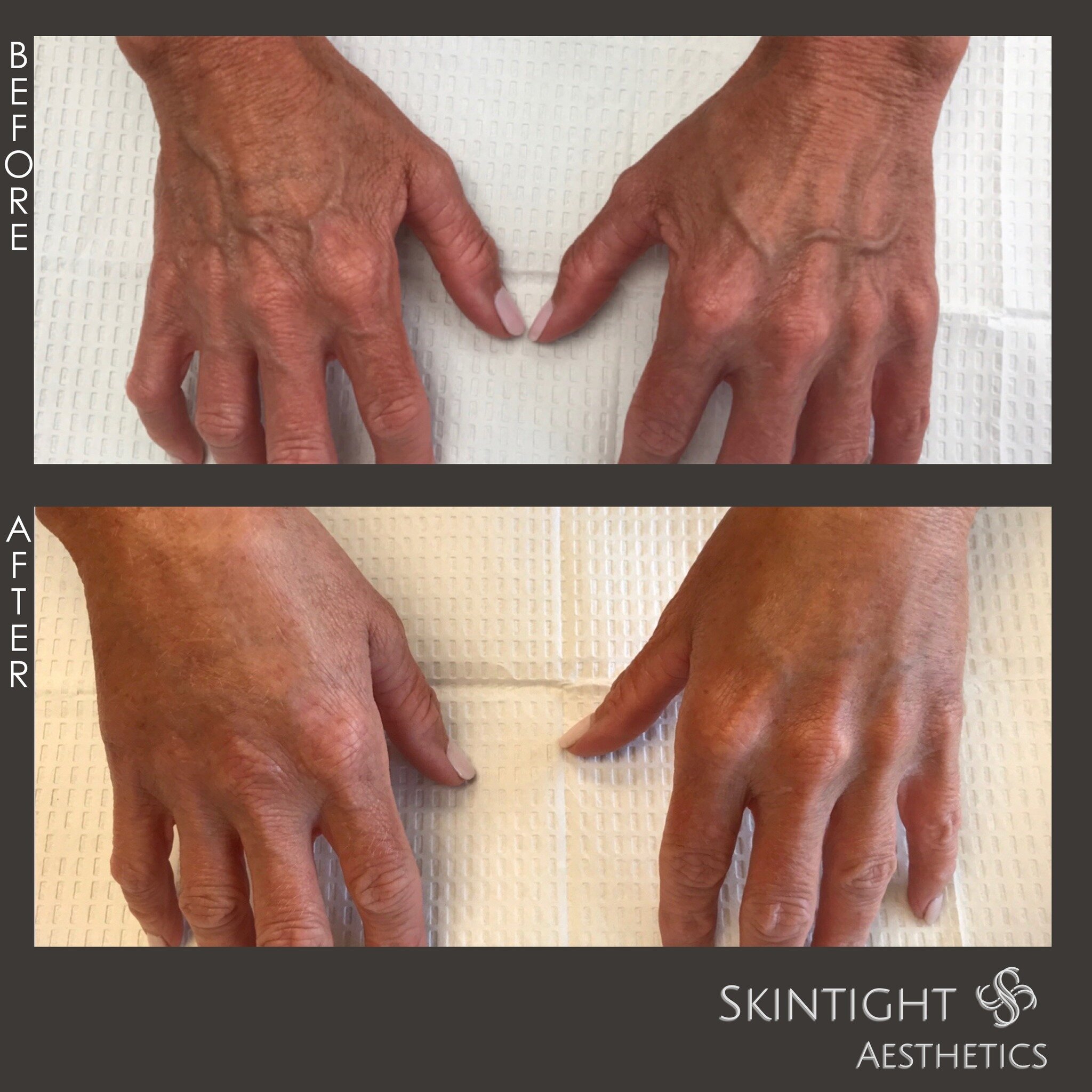 @leighgodfrey1 took decades off these hands! 😍

💉 Treatment: Hand Filler with Radiesse
💵 Price: $850 per Syringe (note: Skintight only charges for the amount used)
⏰ Time: 30 Minutes
🙌🏼 Results: Immediate
🛌 Recovery: Up to 2 Weeks for Swelling 
