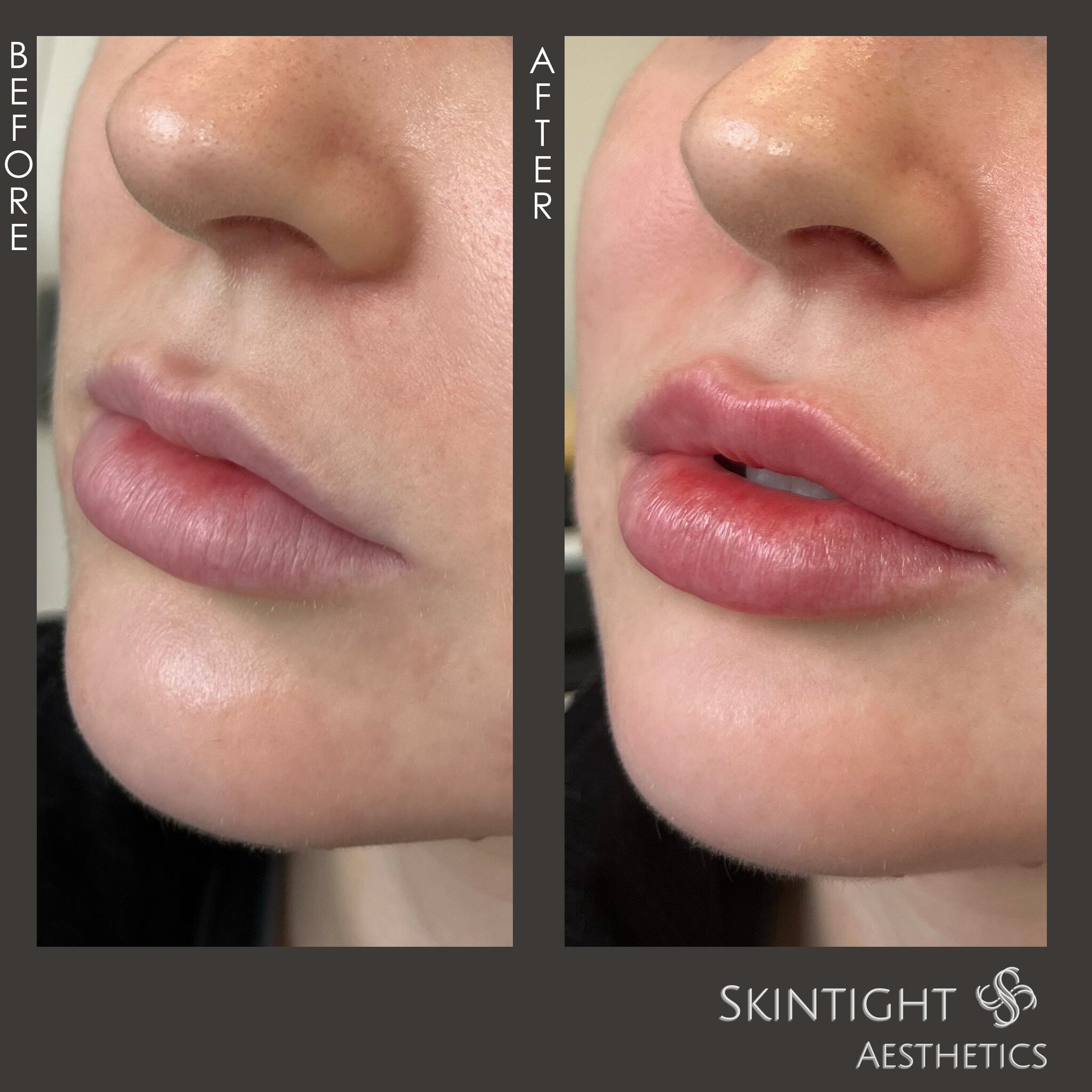 Pretty Pout 💋 by @irina_injectionista 

#lips #lipfiller #beforeafter #beauty